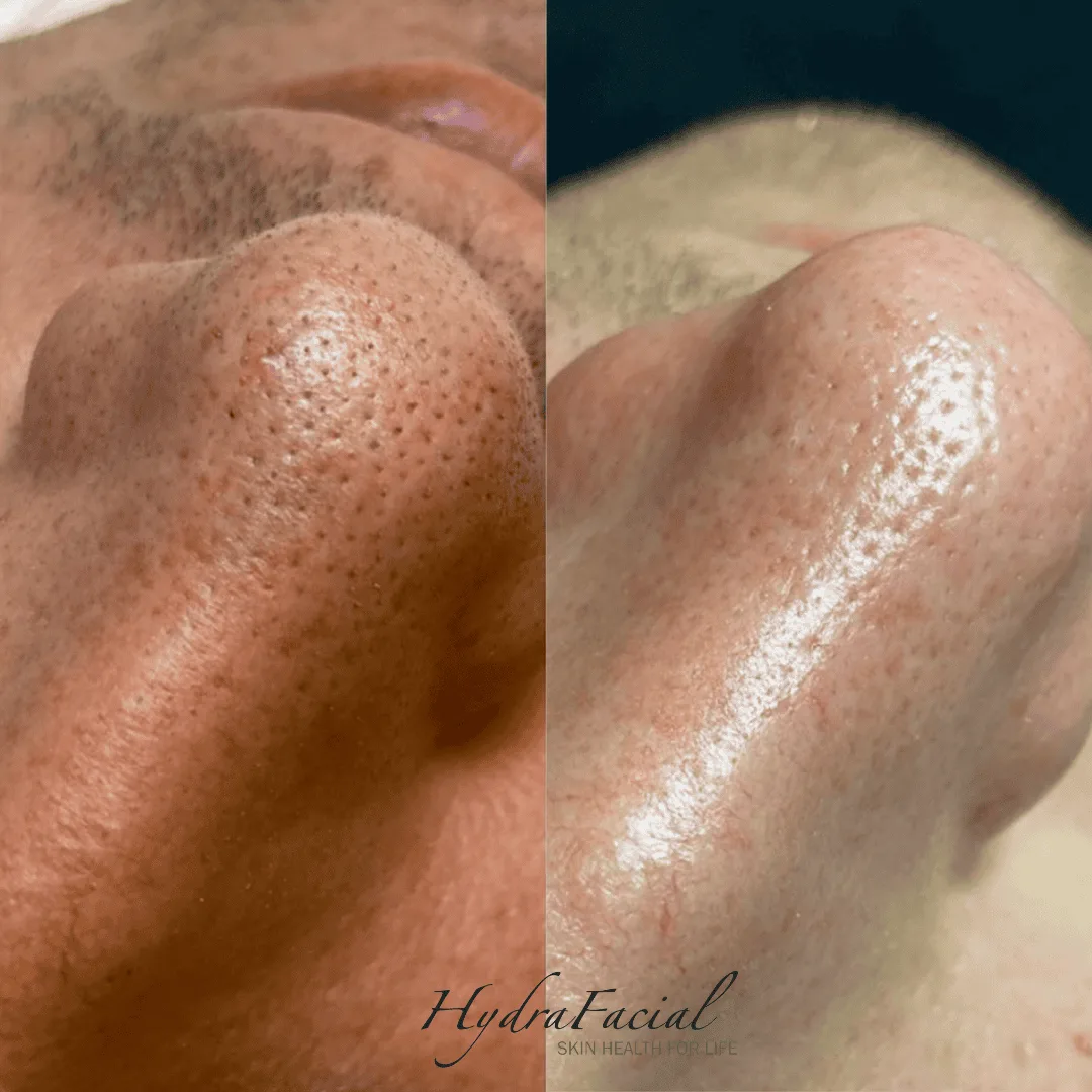 Estetika Hydrafacial prej, potem
