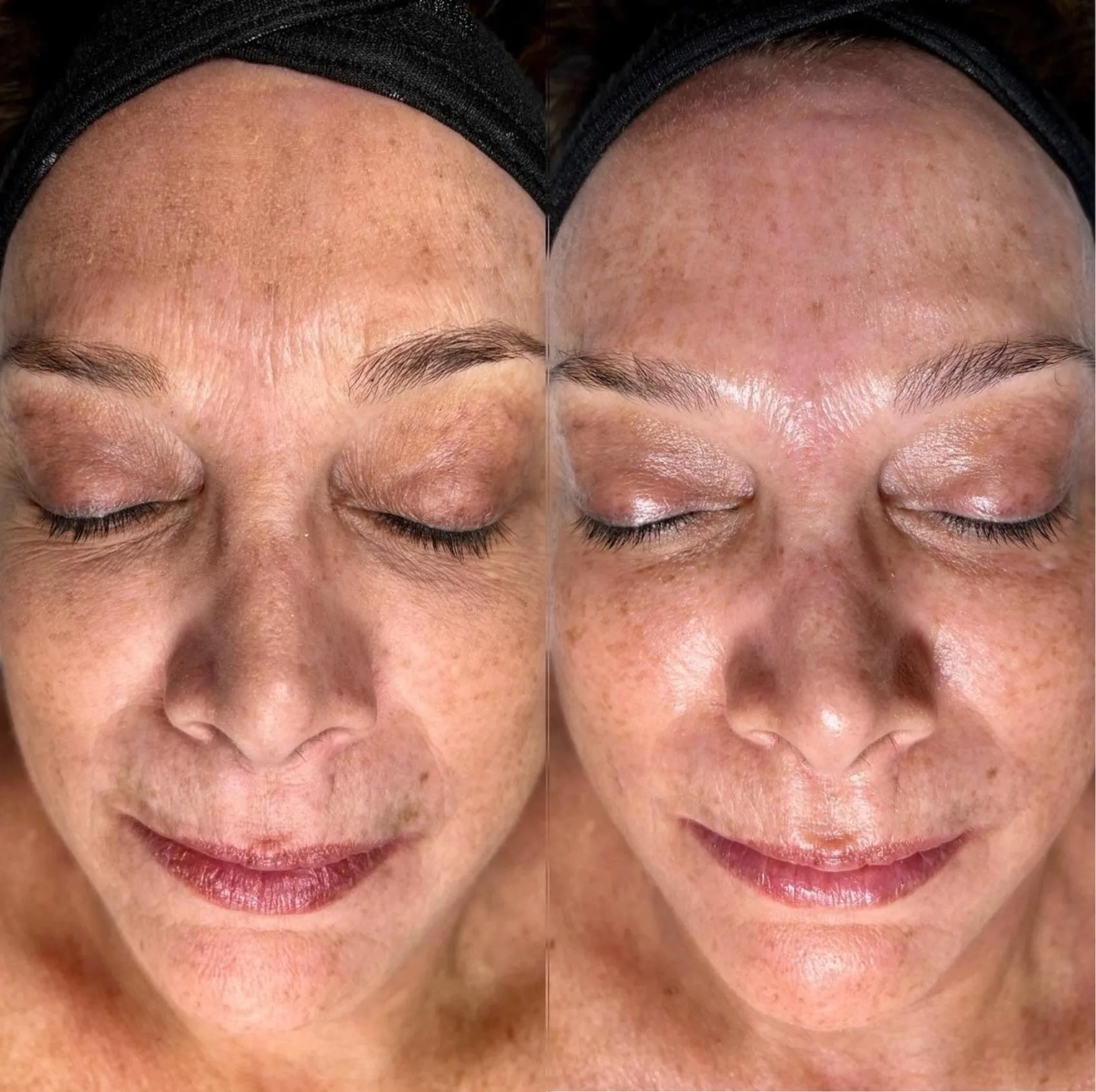 Estetika Hydrafacial prej, potem